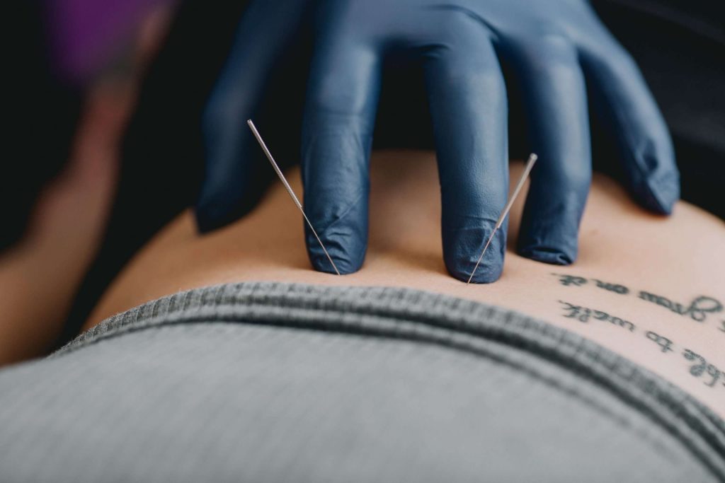 Filiform needles used for dry needling